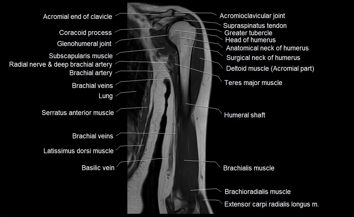 MRI upper arm (humerus ) coronal cross sectional anatomy image 12.webp